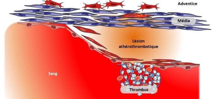 lesion-atherothrombotique